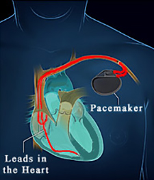 Katy Texas Pacemaker Placement